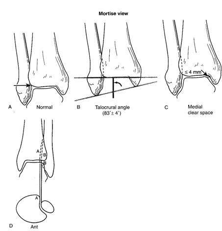 وضعيت راديوگرافيك مچ پاي نرمال mortise view 